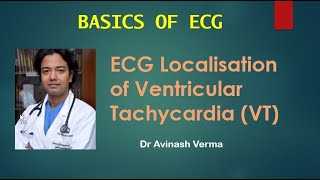 ECG Localisation of VT Ventricular Tachycardia Dr Avinash Varma ECG Academy Session 8 LATE