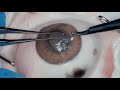 Cornea Suture 101