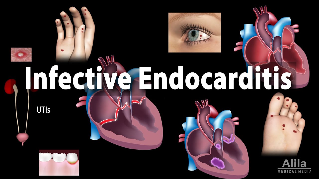 Infective Endocarditis, Animation - YouTube