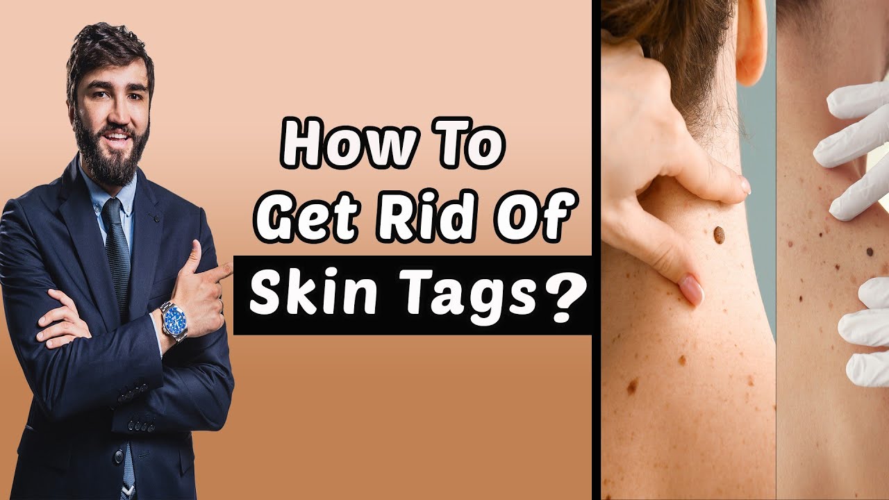 How To Get Rid Of Skin Tags Youtube