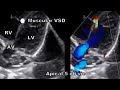 Types of VSD echocardiography