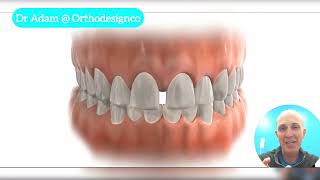 Instructional Video: Turning the expander and troubleshooting palatal expanders