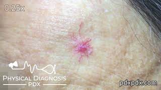 Spider Angioma