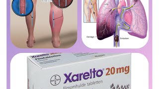 How to take Xarelto \