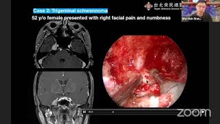 The foramen lacerum: surgical anatomy for endoscopic endonasal approaches