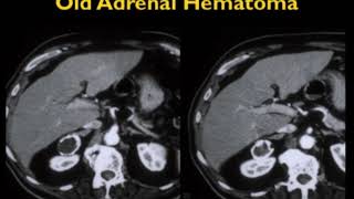 CT of the Adrenal Gland: A Pattern Approach Part 2