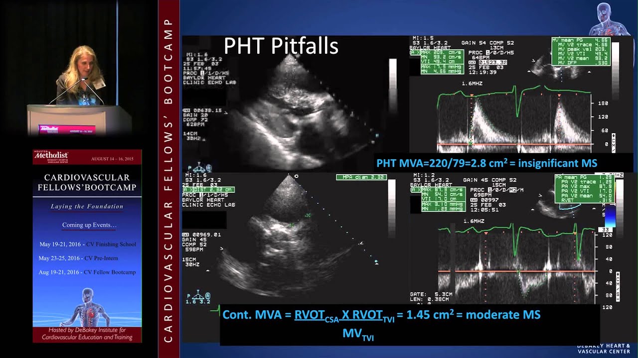 Mitral Stenosis (Karla Kurrelmeyer, MD) - YouTube