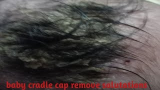 ಶಿಶು ತಲೆಯಲ್ಲಿ ಹೊಟ್ಟು ಏಕೆ? baby cradle cap problem_remove salution