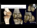 complex knee webinar