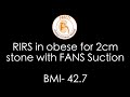 RIRS in obese for 2cm stone with FANS Suction BMI- 42.7