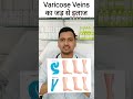 varicose veins treatment without surgery spider veins homeopathic treatment varicose veins ka ilaj