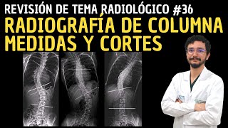 Revisión de Tema Radiológico 36: Radiografía de columna - medidas y cortes.