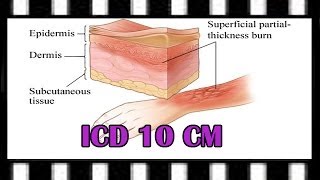 ICD-10 Training — ICD-10-CM Burns and TBSA