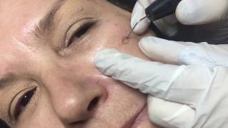 Lentigo treatment by Plasmage ® Brera Medical