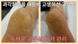 과각화증으로 고생하신분의 두꺼운 굳은살 제거 관리입니다. 여러번 관리 하셨습니다~!