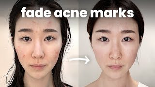 How I Fade Acne Marks Fast (Acne Scars & Hyperpigmentation)