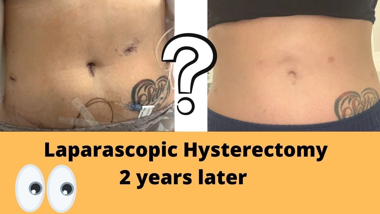 HYSTERECTOMY UPDATE 2 YEARS LATER - YouTube