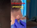 Massive cyst on neck #shorts #pimple #skincare #cystremoval