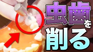 虫歯はどうやって治すの？ 歯医者さんが使う道具、治療方法を全部見せます。【虫歯治療の流れ】