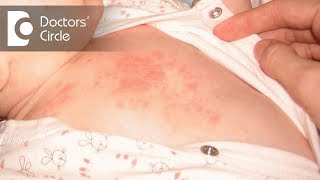 How to manage itchy red spot on stomach of a child? - Dr. Varsha Saxena