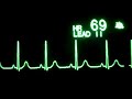 #ECGwaves in Normal sinus rhythm / SENTHAMIL 24*7 TV CHANNEL