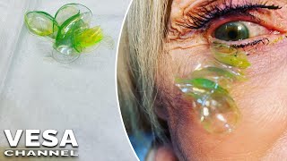 An elderly woman had 23 contact lenses removed from her eyeball