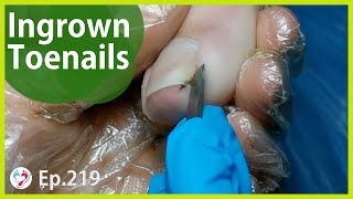 Ep.219 - Ingrown Toenail Treatment Together With Nail Clip