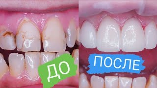 Голливудская улыбка за 2 минуты #shorts