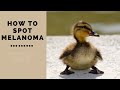 Spotting Skin Cancers & Melanoma With The Ugly Duckling Method - James Goydos 2020