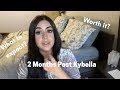 2 Months Post Kybella | What is the KYBELLA experience like?