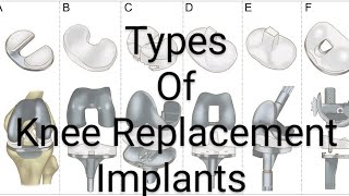 Types Of Knee Replacement Implants based on Constraint | Dr. Prateek Joshi