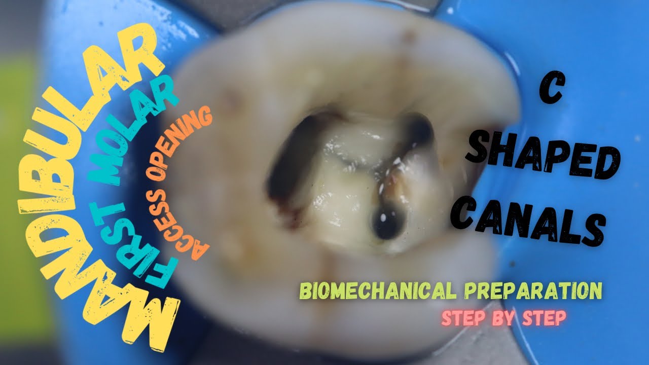 Access Cavity Of Mandibular Molar Lower Molar Access 48 Off