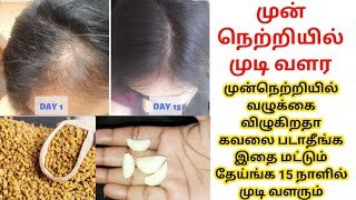 15 Day Hair Growth Miracle /100% Results/ வழுக்கையான இடத்தில் திரும்ப முடி முளைக்க