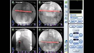 Accuracy of computer navigated percutaneous iliosacral and anterior column screw Placement