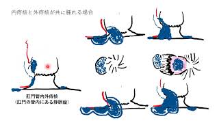 内痔核と肛門管内外痔核、肛門管外外痔核について