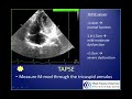 echocardiographic evaluation of right ventricular dysfunction