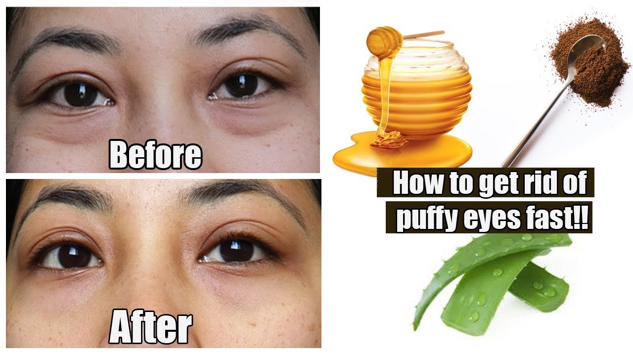 How To Reduce Puffy Eyes In 15 Minutes | Home Remedies - YouTube