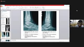 Management of Acute \u0026 Chronic Osteomyelitis | Orthopaedics