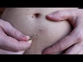 Longest ingrown hair removal below belly button