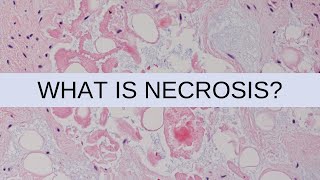 What is Necrosis? - Pathology mini tutorial