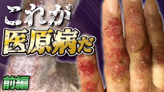 【これが医原病だ！！】前編　ステロイドがもたらす悲劇！！