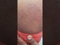 tinea corporis ringworm