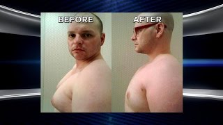 Man Whose Chest Was Ruining His Life Returns after Life-Changing Surgery