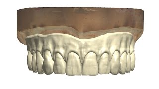 Prettau Implant screw retained bridge 2015