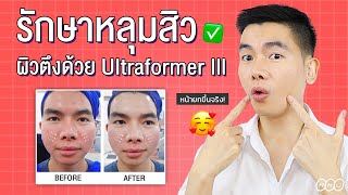 [รีวิว] รักษาหลุมสิวผิวใส ผิวกระชับ ลดริ้วรอยด้วย Ultraformer III