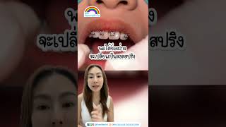 วิธีแก้ปัญหาฟันซ้อนเก | คลินิกทันตกรรมฟ้าใส | จัดฟันระยอง