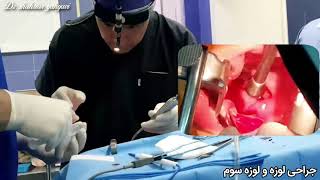 فیلم جراحی لوزه - Tonsil surgery video