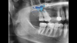 Dental Implant Placement BY Dr.Anwar AL-Abdullah