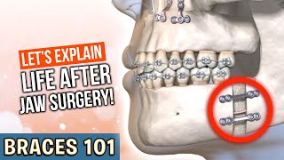 Life After JAW SURGERY! | Treatment Minute Talk!