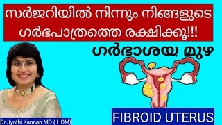 ഗർഭാശയ ഫൈബ്രോയിഡ് - Fibroid uterus